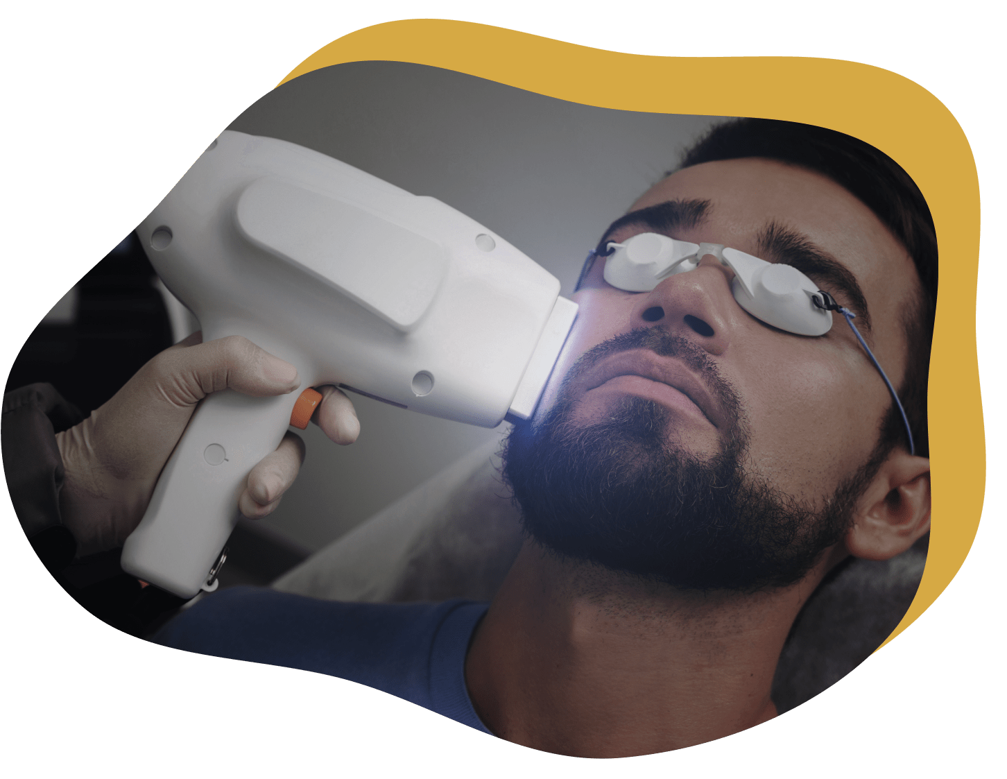 Epilazione laser della barba a Praga obrázek 1